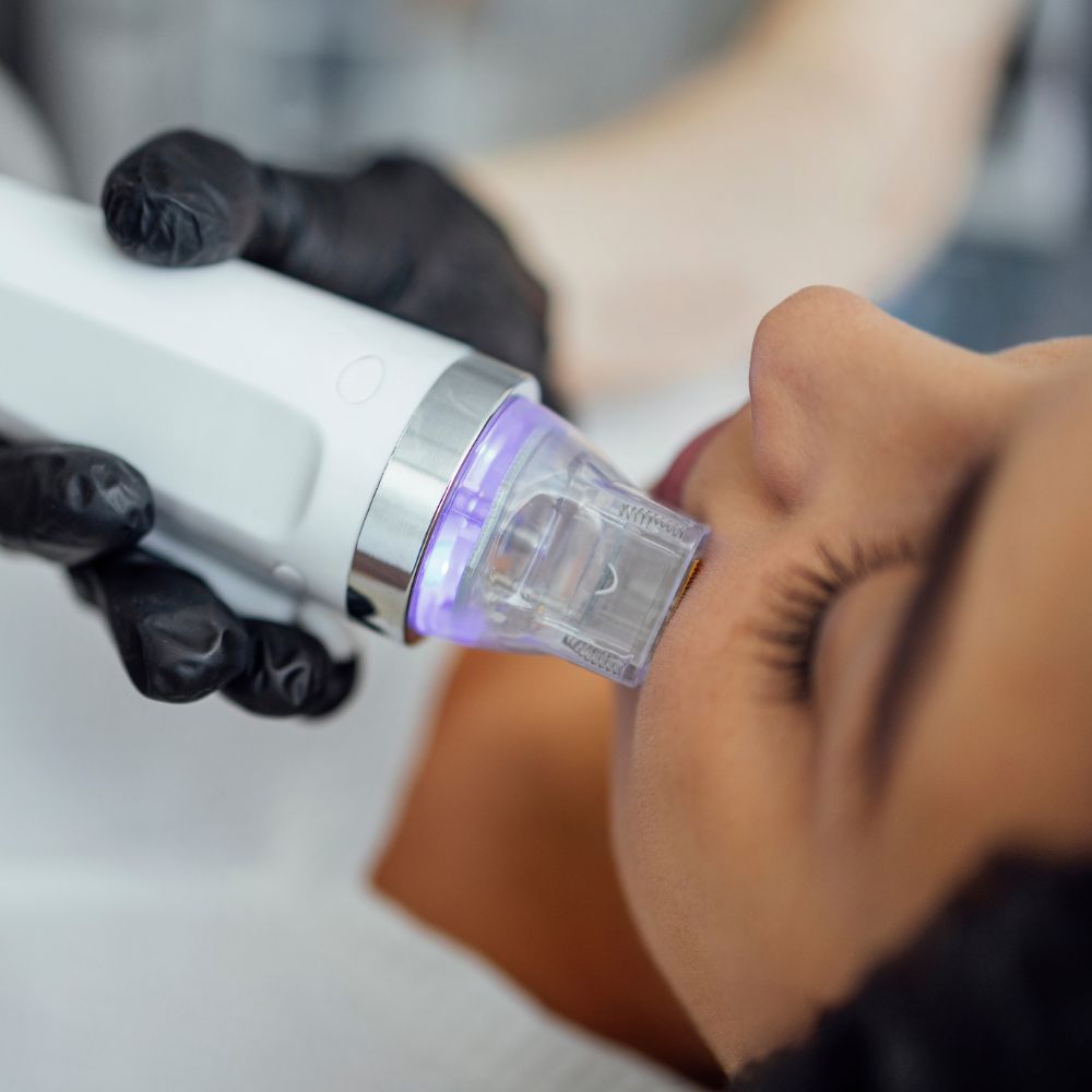 Zbliżenie na twarz osoby podczas zabiegu frakcyjnego mikroigłowego. Specjalista w czarnych rękawiczkach przykłada do skóry urządzenie z przezroczystą końcówką emitującą światło.