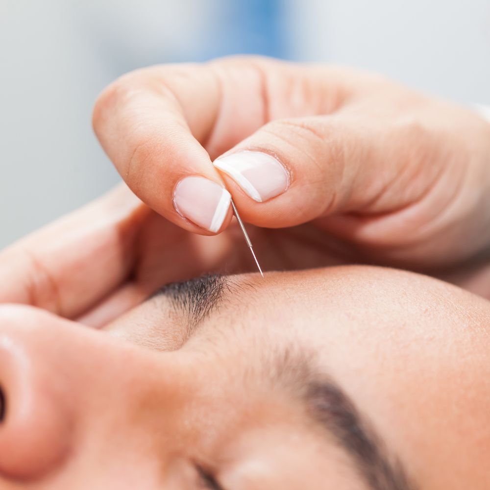 Zbliżenie na twarz osoby z zamkniętymi oczami podczas zabiegu akupunktury. Specjalista delikatnie umieszcza cienką igłę nad linią brwi.