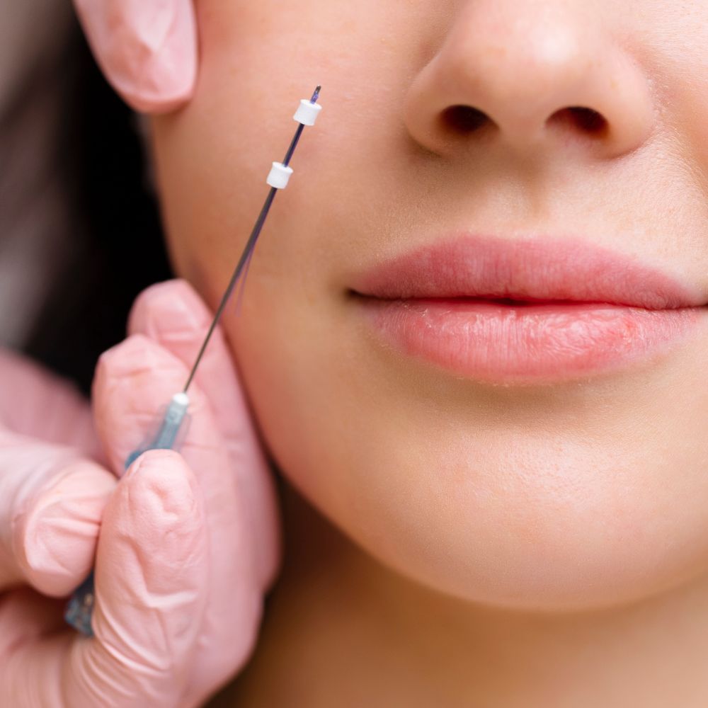 Preparacja nici liftingującej przy okolicy ust podczas zabiegu estetycznego w gabinecie